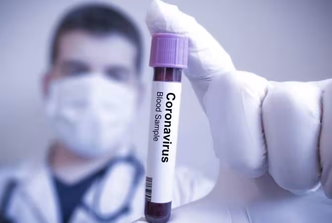 84 cas confirmés de coronavirus en Arménie